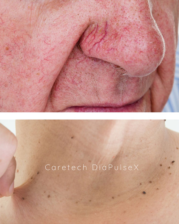  Caretech DiapulseX